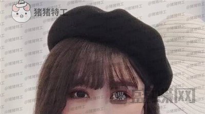 北京百达丽,上海九院,苏婷,双眼皮,修复,案例,价格,