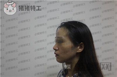 成都西区医院,毛健清,面部填充,案例,价格,