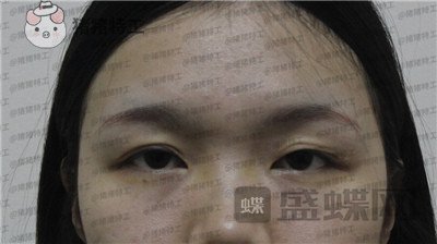 成都西区医院,车红昌,双眼皮,案例,价格,