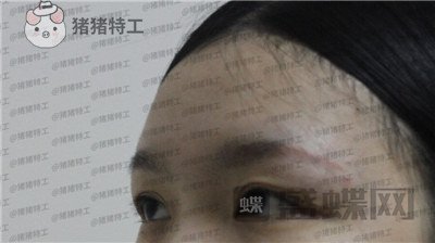 成都西区医院,车红昌,双眼皮,案例,价格,