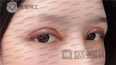 成都西区医院,车红昌,双眼皮,案例,价格,