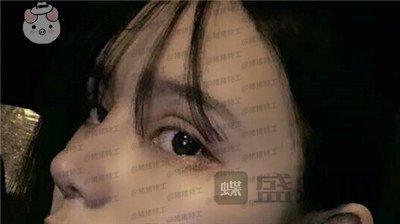 成都西区医院,车红昌,双眼皮,案例,价格,