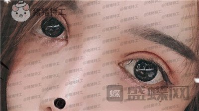 成都西区医院,车红昌,双眼皮,案例,价格,