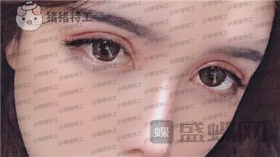 成都西区医院,车红昌,双眼皮,案例,价格,