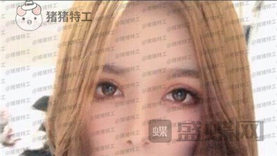 成都西区医院,车红昌,双眼皮,案例,价格,
