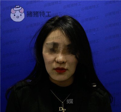 北京壹加壹,张绿峰,面部填充,案例,价格,