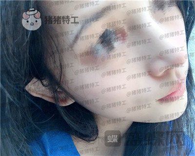 福州美贝尔,赵栋材,隆鼻,案例,价格,