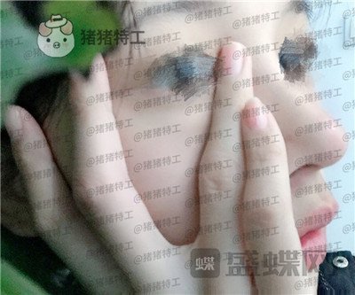 福州美贝尔,赵栋材,隆鼻,案例,价格,