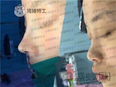 福州美贝尔,赵栋材,隆鼻,案例,价格,