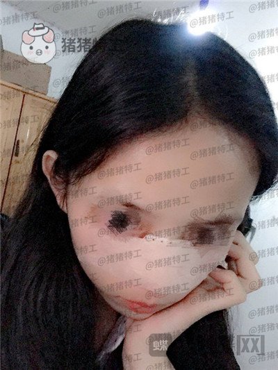 福州美贝尔,赵栋材,隆鼻,案例,价格,