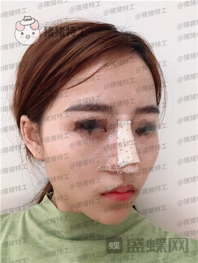 重庆当代,王旭明,鼻部手术,案例,价格,