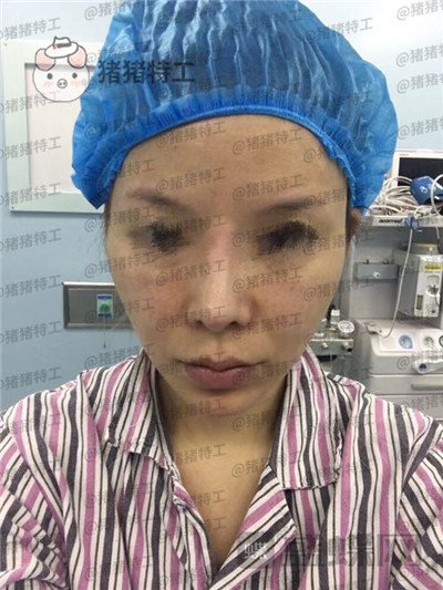 成都天使之翼,尤军,面部填充,案例,价格,
