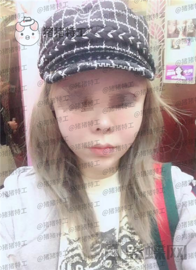 成都天使之翼,尤军,面部填充,案例,价格,