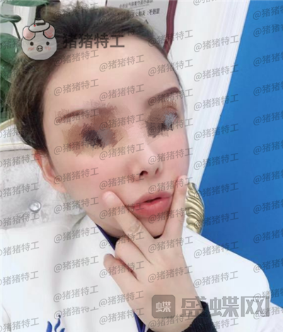 成都天使之翼,尤军,面部填充,案例,价格,