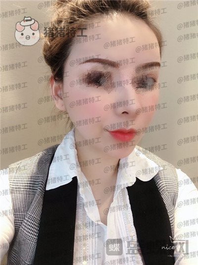 成都天使之翼,尤军,面部填充,案例,价格,