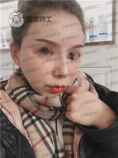成都天使之翼,尤军,面部填充,案例,价格,