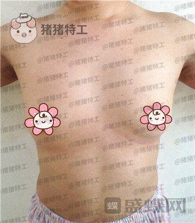 沧州华美,白伟枫,隆胸,案例,价格,