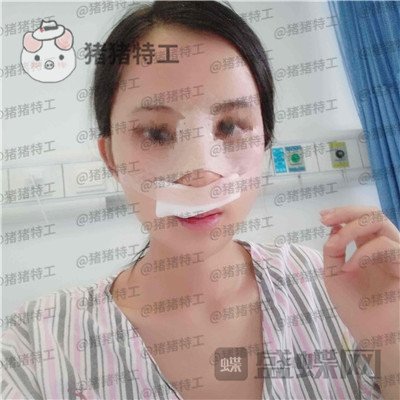 长沙美莱,斌,鼻部手术,案例,价格,