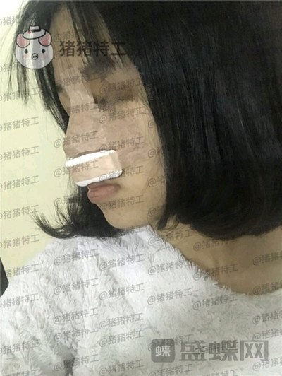 重庆军美,曾令宇,隆鼻,案例,价格,