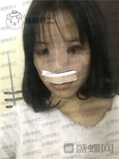 重庆军美,曾令宇,隆鼻,案例,价格,