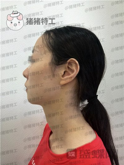 南京美贝尔,黄名斗,面部填充,案例,价格,