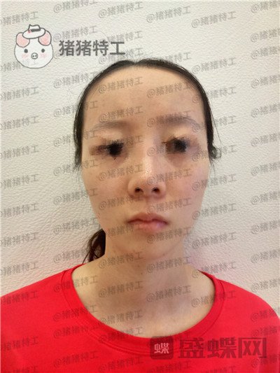 南京美贝尔,黄名斗,面部填充,案例,价格,