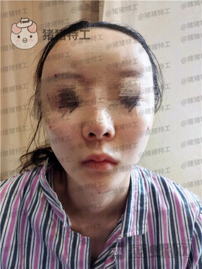 南京美贝尔,黄名斗,面部填充,案例,价格,