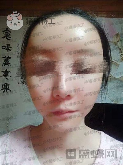 南京美贝尔,黄名斗,面部填充,案例,价格,