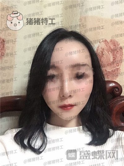 南京美贝尔,黄名斗,面部填充,案例,价格,