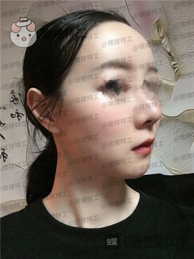 南京美贝尔,黄名斗,面部填充,案例,价格,