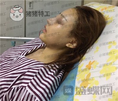 邯郸雅丽,刘雅丽,隆鼻,案例,价格,