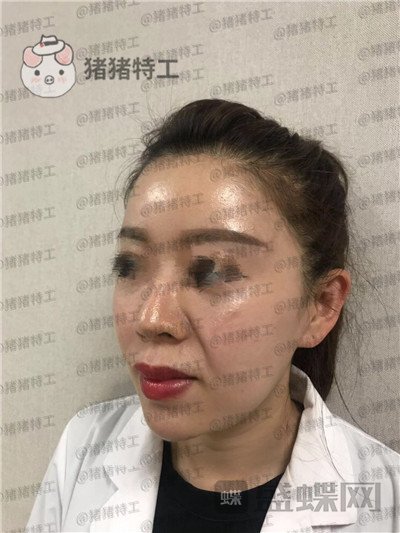 北京炫美,徐学东,垫鼻基底,案例,价格,