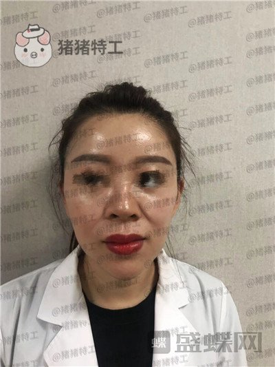 北京炫美,徐学东,垫鼻基底,案例,价格,