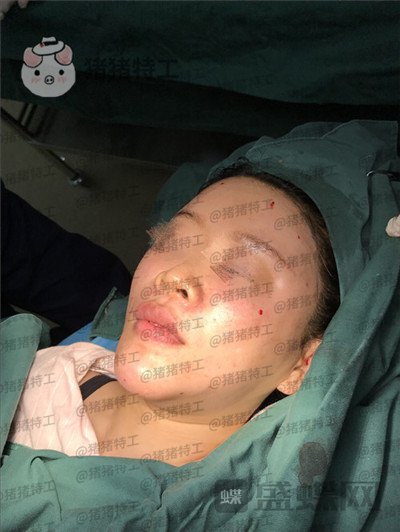 北京炫美,徐学东,垫鼻基底,案例,价格,