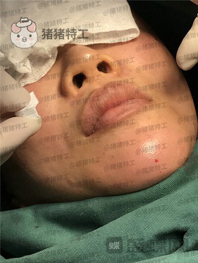 北京炫美,徐学东,垫鼻基底,案例,价格,