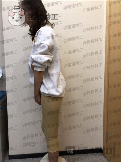 重庆瑞俪,胡小义,吸脂,案例,价格,