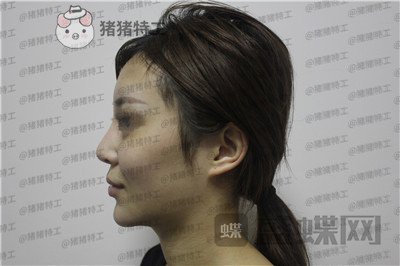 成都西区医院,肖凌,鼻修复,案例,价格,