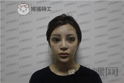 成都西区医院,肖凌,鼻修复,案例,价格,