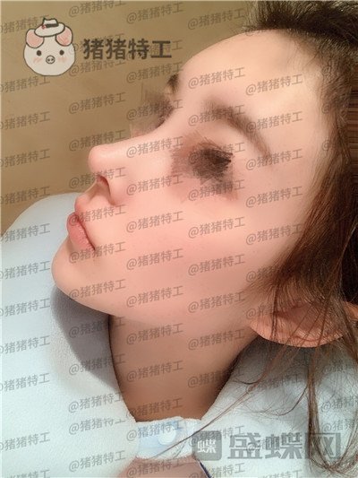 成都西区医院,肖凌,鼻修复,案例,价格,