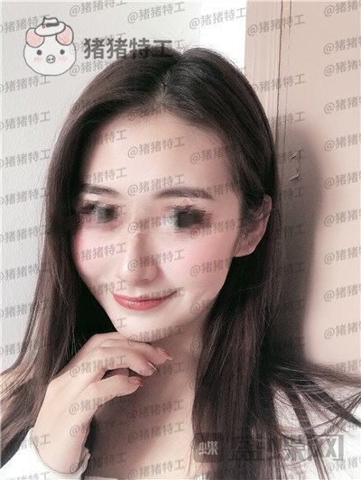 南京美贝尔,黄名斗,面部填充,案例,价格,