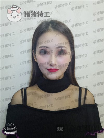 南京美贝尔,黄名斗,面部填充,案例,价格,