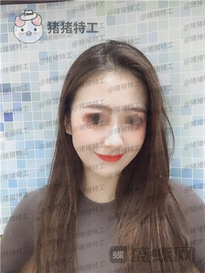 南京美贝尔,黄名斗,面部填充,案例,价格,