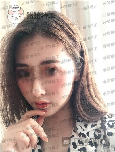 南京美贝尔,黄名斗,面部填充,案例,价格,