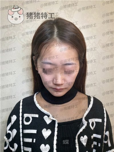 南京美贝尔,黄名斗,面部填充,案例,价格,