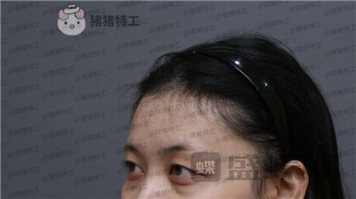 武汉美基元,,双眼皮,案例,价格,