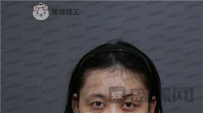 武汉美基元,,双眼皮,案例,价格,