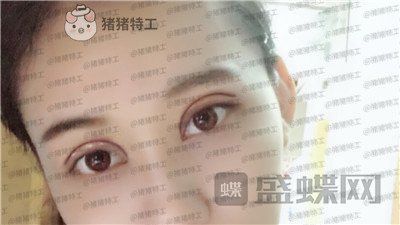 武汉美基元,,双眼皮,案例,价格,
