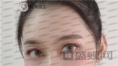 武汉美基元,,双眼皮,案例,价格,