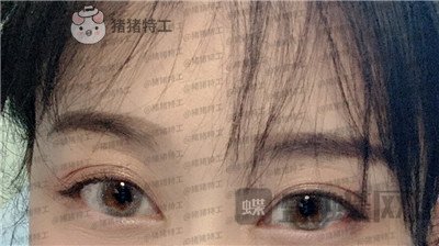 武汉美基元,,双眼皮,案例,价格,