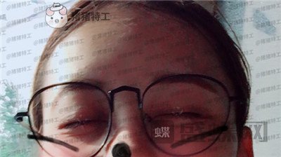 武汉美基元,,双眼皮,案例,价格,